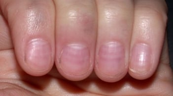 Nhìn móng tay bắt bệnh cực kỳ chính xác
