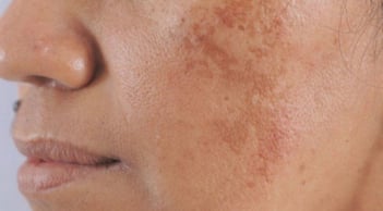 Bạn bị đốm đồi mồi, tàn nhang thường là do 3 điều này, hãy chủ ý đển chúng để có làn da đẹp