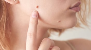 3 vị trí mọc nốt ruồi dễ thành ung thư da: Cảnh báo đừng xem thường