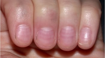 Nhìn móng tay bắt bệnh cực chuẩn