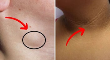 Người sắp bị K thường có 3 dấu hiệu bất thường ở cổ: Dù chỉ có 1 cũng phải đi khám ngay