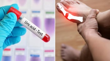 8 cách đơn giản giúp đào thải axit uric ra khỏi cơ thể, phòng ngừa bệnh gout