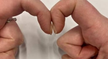 4 dấu hiệu bất thường trên ngón tay cảnh báo sớm ung thư gan, phổi