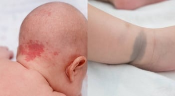 Cảnh báo: Những dấu hiệu 'nốt ruồi son - bớt - vết chàm' trên trẻ có thể tiềm ẩn nguy cơ bệnh lý