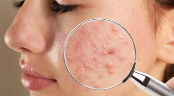 Cẩm nang chăm sóc các loại mụn ẩn nàng nên biết