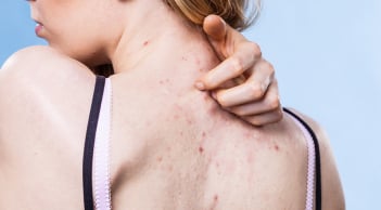 Nguyên nhân gây ra mụn lưng và biện pháp khắc phục tình trạng này.