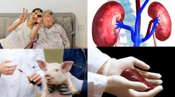 Ca ghép thận lợn đầu tiên ở châu Á sống hơn 200 ngày