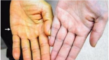 5 dấu hiệu cảnh báo bệnh gan của bạn đã đi vào giai đoạn nặng: Có 1 cũng nên đi khám sớm