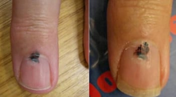 Cảnh báo sức khỏe: 6 bộ phận màu đen thường báo hiệu nguy cơ ung thư, đừng chủ quan!