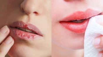 Cách trị môi khô nứt nẻ bằng nguyên liệu sẵn có tại nhà để mùa đông khô hanh nhưng môi vẫn căng mọng