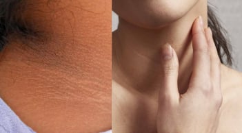 Nhìn thấy dấu hiệu này trên da, cẩn thận Tiểu Đường tới gần
