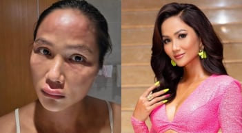 H'Hen Niê mắc bệnh sau sinh, khuôn mặt biến dạng khó nhận ra