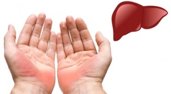 6 dấu hiệu bất thường ở bàn tay, cảnh báo bệnh bạn đang mắc phải