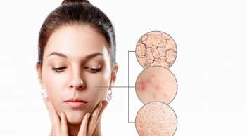 Nàng có làn da nhiều khuyết điểm, lỗ chân lông to nên tránh những sản phẩm nào?