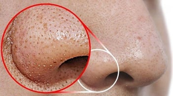 Cách chăm sóc vùng mũi giúp giảm mụn đầu đen và làm mịn da
