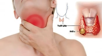 7 dấu hiệu sớm của K tuyến giáp, nhiều người chủ quan bỏ qua