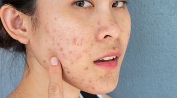 Một làn da đẹp không phải là làn da “sạch bóng” dầu