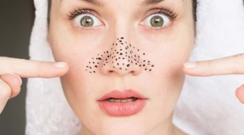 4 mặt nạ trị mụn đầu đen từ nguyên liệu nhà bếp giúp da sạch thoáng tự nhiên