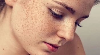 4 loại nám da thường gặp và cách điều trị