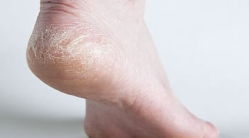 Mẹo giai quyết tình trạng da gót chân khô, nứt nẻ