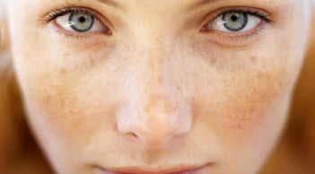 3 loại nước ép giàu vitamin A và C chăm sóc làn da và trị nám cực hiệu quả