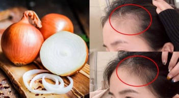 Mẹo sử dụng hành tây giúp tóc con mọc tua tủa, càng dùng tóc càng dày và bóng mượt