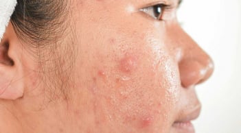 Cách chăm sóc da mụn đúng cách trong mùa đông