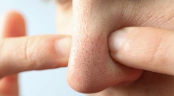 3 mẹo đơn giản giải quyết nỗi lo mụn đầu đen cho nàng