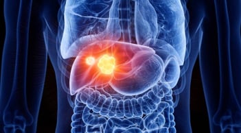 Ung thư gan gia tăng đáng báo động: Bác sĩ chỉ ra 4 thực phẩm phá gan còn nhanh hơn rượu bia