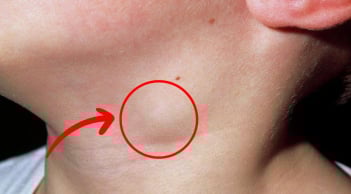 3 dấu hiệu bất thường ở vùng cổ cảnh báo K: Nhiều người chủ quan đã quá muộn