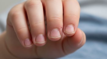 Trẻ hay cắn móng tay tưởng vô hại, bé 5 tuổi phải phẫu thuật vì nhiễm trùng nặng: Bố mẹ đừng chủ quan