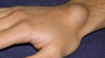 Cảnh báo ung thư giai đoạn cuối: Đừng bỏ qua 4 dấu hiệu bất thường trên cơ thể