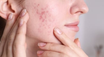 Thâm mụn và lộ trình chăm sóc giúp da phục hồi nhanh hơn