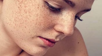 Đốm đồi mồi trên da: nguyên nhân, dấu hiệu và cách cải thiện hiệu quả