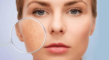 5 cách cải thiện lỗ chân lông to theo bác sĩ da liễu