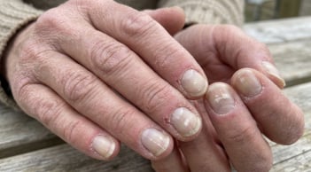 Tay và chân xuất hiện 7 dấu hiệu này, có thể là tín hiệu thận đang gặp vấn đề