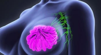 5 dấu hiệu ung thư vú dễ nhận biết nhưng nhiều người bỏ qua: Cẩn thận di căn xa