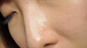 4 nguyên nhân khiến lỗ chân lông to và cách chăm sóc phù hợp cho từng tình trạng da