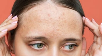 Nhận diện sẹo rỗ và 5 phương pháp cải thiện giúp làn da dần mịn màng hơn