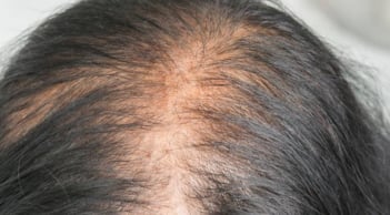 Loại lá chống rụng tóc, kích thích mọc tóc con hiệu quả nhưng đang bị bỏ phí