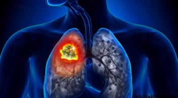 5 dấu hiệu vào buổi tối cảnh báo ung thư: Đặc biệt số 2 rõ ràng mà nhiều người chủ quan