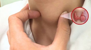 5 nhóm người có nguy cơ cao bị ung thư tuyến giáp