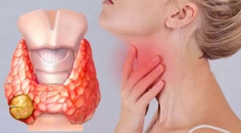 5 dấu hiệu ung thư tuyến giáp giai đoạn 1: Biết sớm sẽ kéo dài sự sống