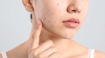 Giảm mụn ẩn hiệu quả: xây dựng quy trình chăm sóc da đúng cách từ những bước cơ bản