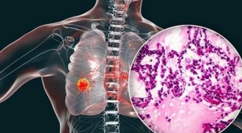 Cảnh báo ung thư phổi gia tăng: Bác sĩ khuyên tránh 4 loại thực phẩm để lâu trong tủ lạnh