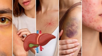 Da xuất hiện 5 dấu hiệu này, đừng chủ quan: Gan có thể đang “kêu cứu”