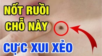 4 nốt ruồi hao tài, nên hóa giải kẻo hao tài khánh kiệt