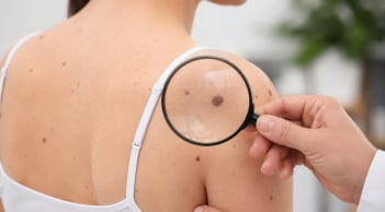  5 dấu hiệu bất thường trên da có thể cảnh báo nguy cơ ung thư: đừng chủ quan