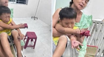 Cháu bé bị dập bàn tay nghi do điện thoại nổ khi đang sạc pin