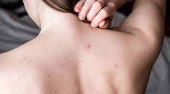 Cải thiện mụn lưng và da sần sùi tại nhà: Routine đơn giản giúp da body mịn màng rõ rệt